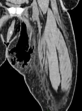 Figure 4 for case Necrotizing fasciitis ( RID3447 )